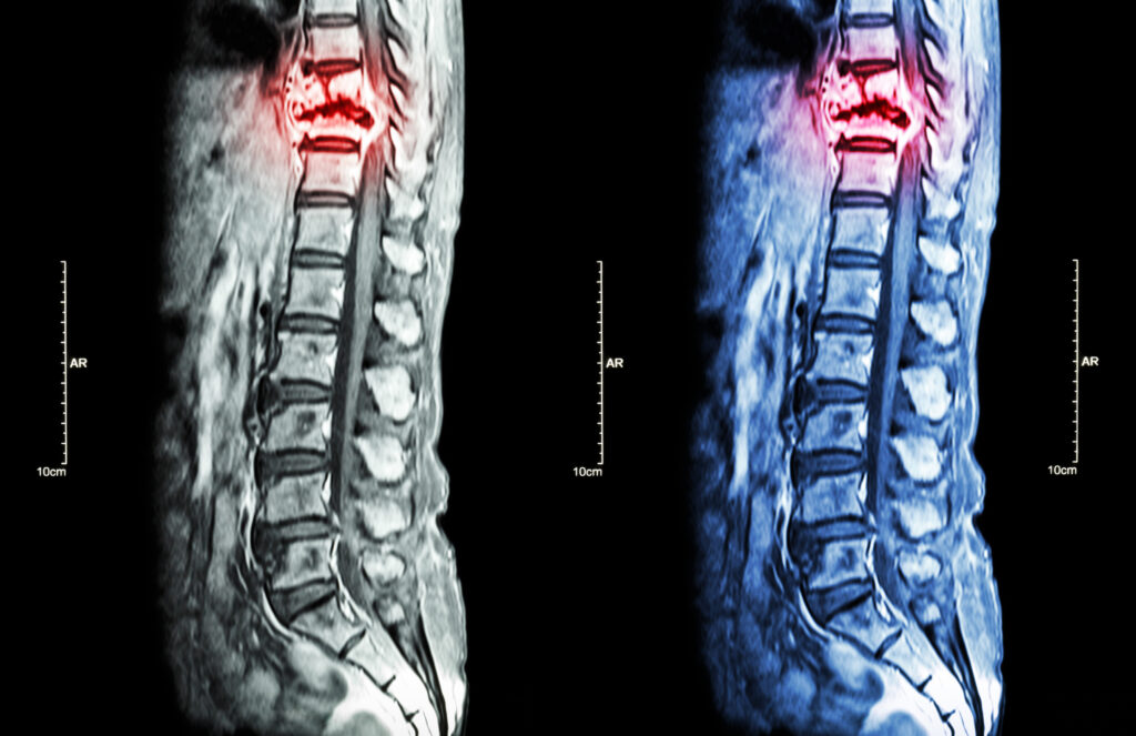 Why You Might Need an Athens Spinal Cord Injury Lawyer After a Crash